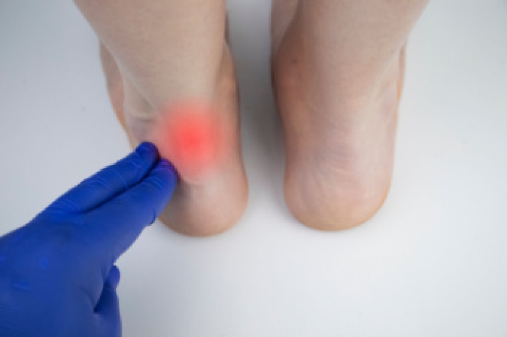 Achilles Tendon Injuries and the Thompson Test