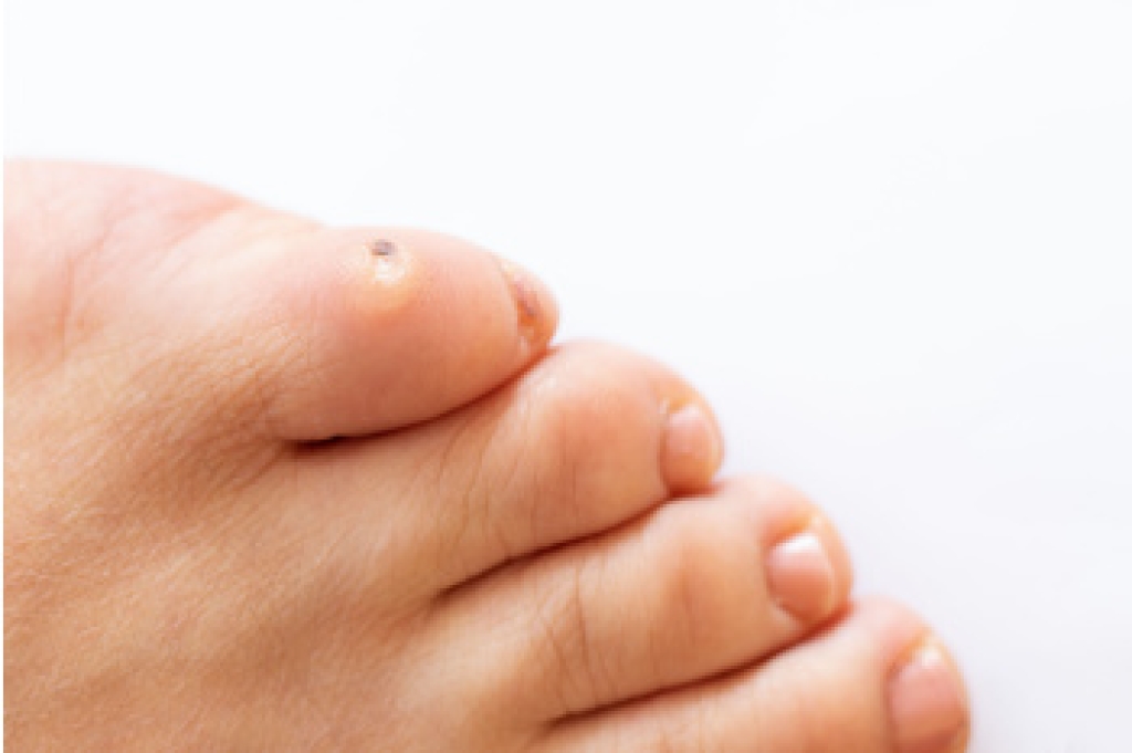 Managing Recurring Corns on the Feet