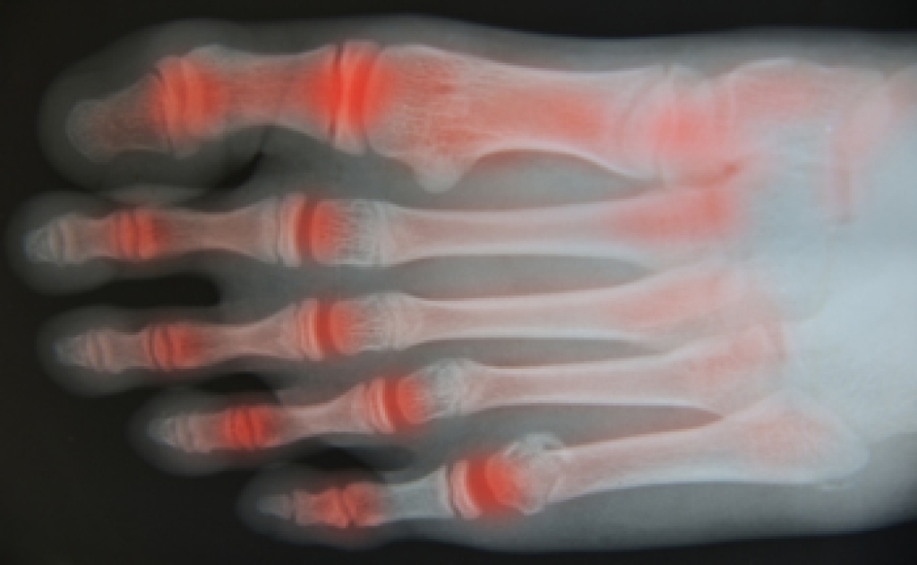 Ankle Osteoarthritis and the Impact of Past Injuries