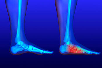 Flat feet and Fallen Arches treatment in the Chicago Heights, Olympia Fields, IL 60461 area