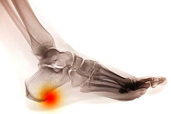 Heel spurs treatment in the Chicago Heights, Olympia Fields, IL 60461 area