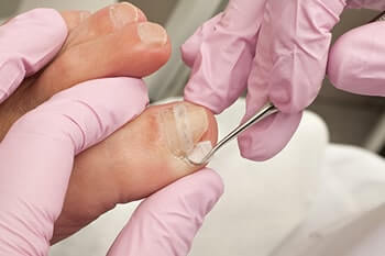 Ingrown toenails treatment in the Olympia Fields, IL 60461 area