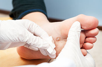 Plantar warts treatment in the Chicago Heights, Olympia Fields, IL 60461 area