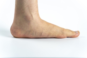 Flat Feet Risks