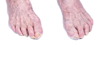 Common Toenail Problems in Older Adults