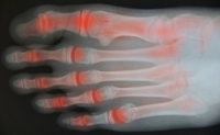 When Rheumatoid Arthritis Affects the Ankle