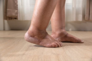 Common Reasons for Swollen Feet and Ankles