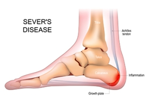 What Is Sever&rsquo;s Disease?