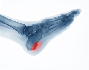 When Is Heel Spur Surgery Needed?