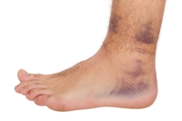 Dealing With an Ankle Sprain