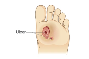 Diabetic Foot Infections and Podiatric Care