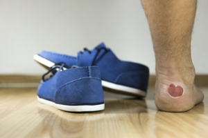 Causes and Podiatric Care for Blisters on the Feet