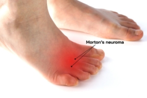 Understanding Morton&rsquo;s Neuroma
