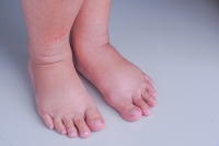 Swollen Feet During Pregnancy Is Considered to Be Normal