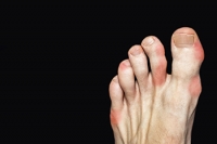 Gout Is a Common Form of Arthritis