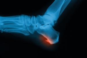 Explaining Heel Spur Surgery