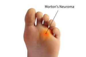 Morton&rsquo;s Neuroma and Forefoot Pain