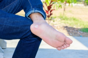 Dealing With Plantar Warts