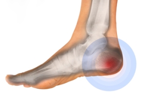 Recognizing Heel Stress Fractures