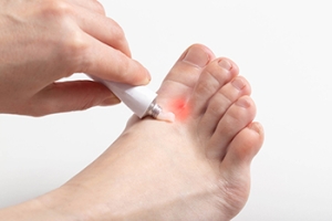 Dealing With Athlete&rsquo;s Foot